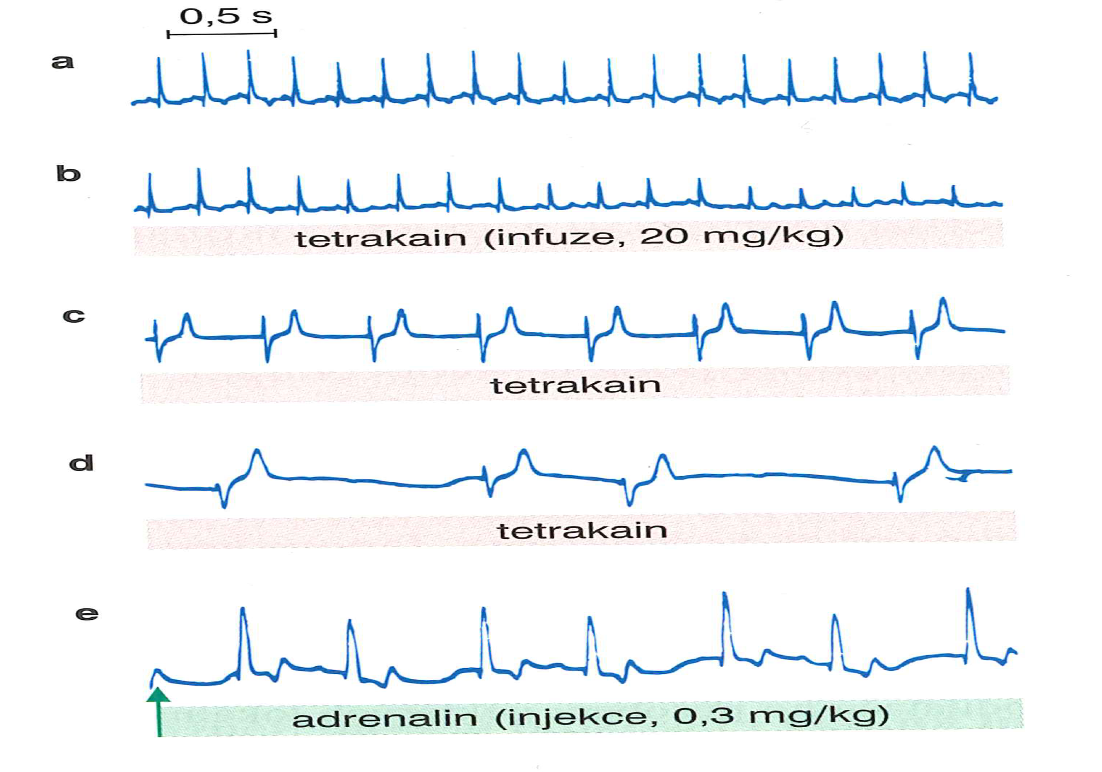 Změny EKG při toxické reakci LA