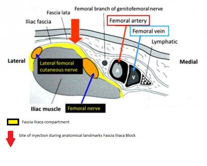 Fascia iliaca compartment block for femoral bone fractures in prehospital care.